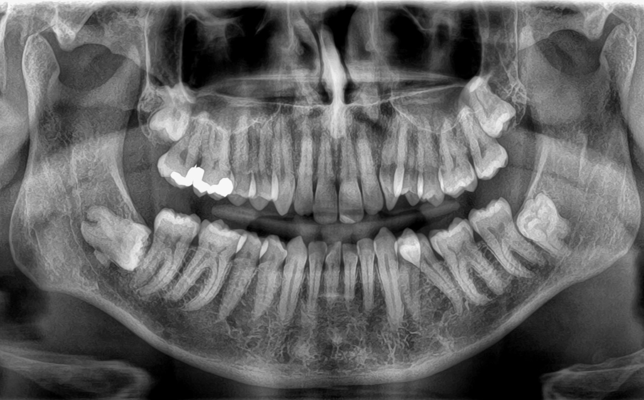 جراحی دندان عقل نهفته شیراز