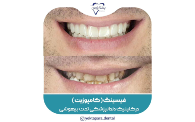 تفاوت لمینت و کامپوزیت