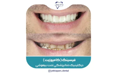 فیسینگ دندان در شیراز