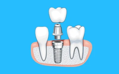 بهترین برندهای ایمپلنت در شیراز