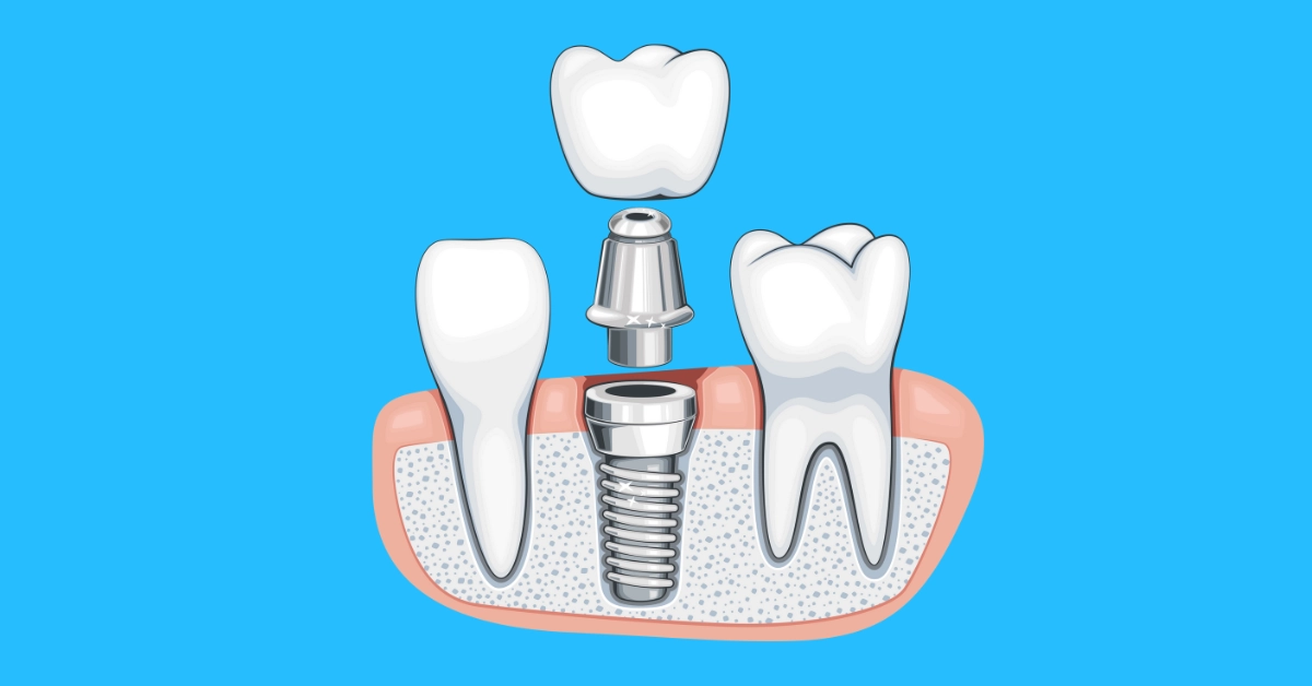 بهترین برندهای ایمپلنت در شیراز