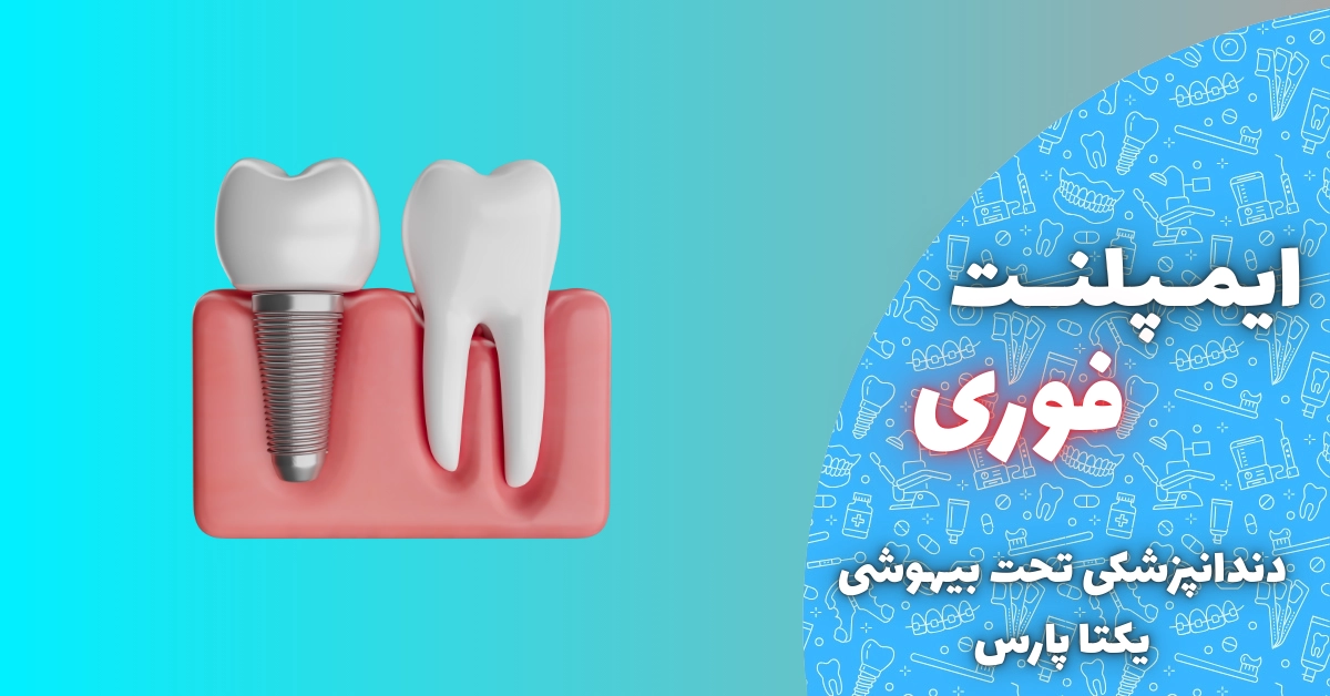 ایمپلنت فوری در شیراز
