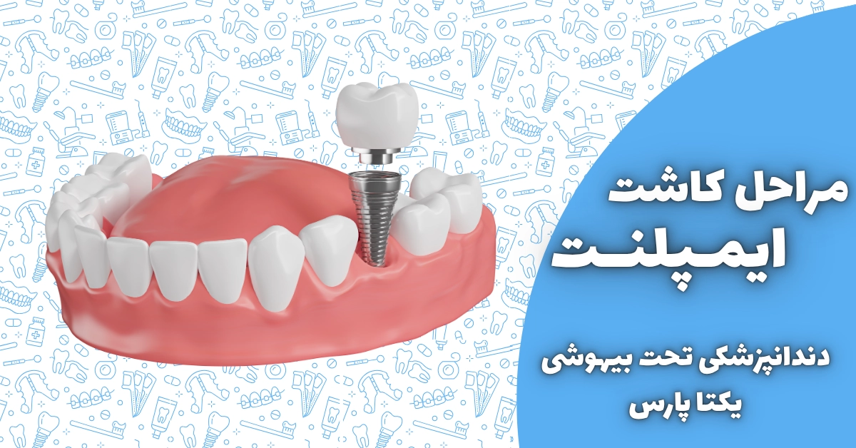 مراحل کاشت ایمپلنت دندان