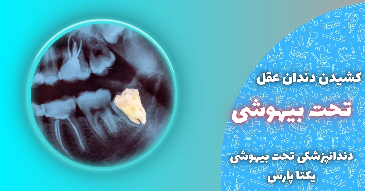 کشیدن دندان عقل تحت بیهوشی شیراز