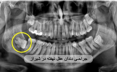 جراحی دندان عقل نهفته در شیراز